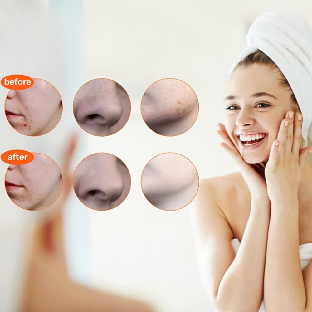 15Pcs Stainless Steel Blackhead Remover Pimple Popper Tools Kit with Metal Case - Direct On Sale